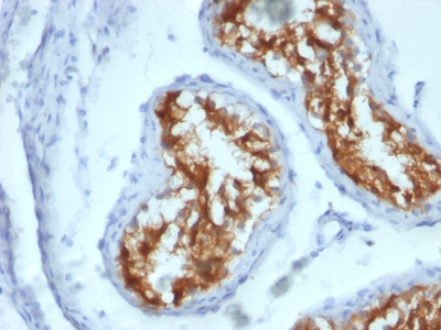 FFPE human testicular carcinoma sections stained with 100 ul anti-Fascin-1 (clone FSCN1/417) at 1:400. HIER epitope retrieval prior to staining was performed in 10mM Citrate, pH 6.0.
